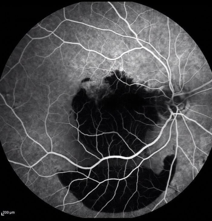 Wet Macular Degeneration - Fluorescein Angiography