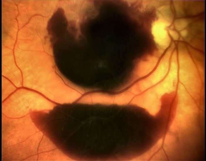 Color photo of Wet AMD