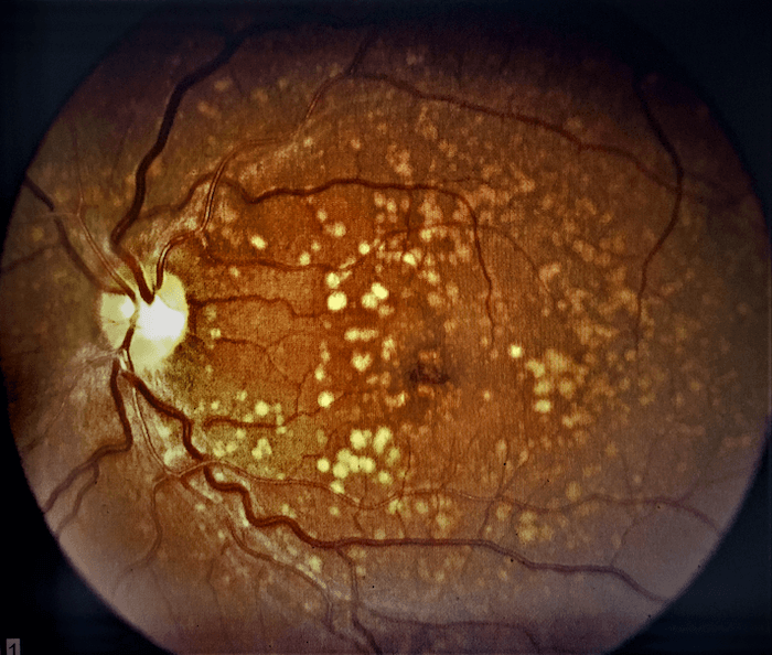 Retina with Drusen