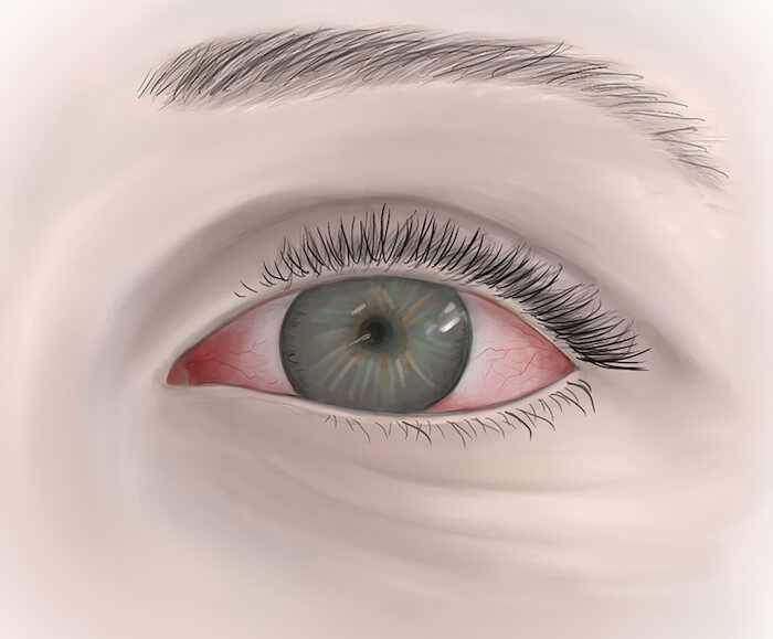 Illustration of inflamed, red eye