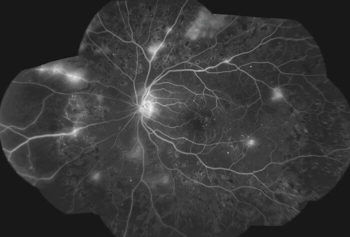Diabetic Retinopathy as seen with Fluorescein angiography