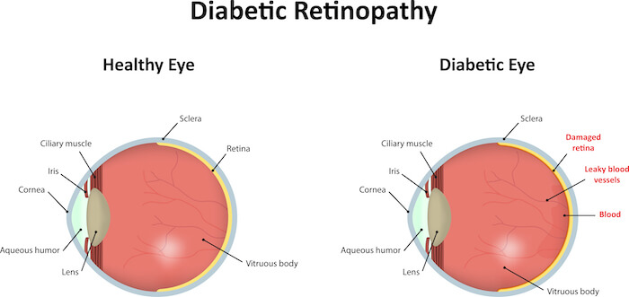 Diabetic Retinopathy diagram