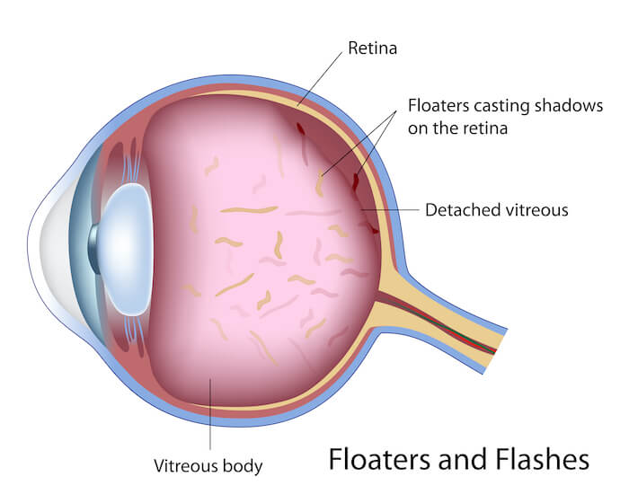 Diagram of flashes and floaters