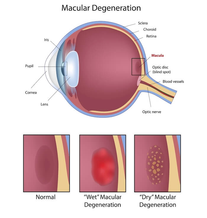 Diagram of macular degeneration