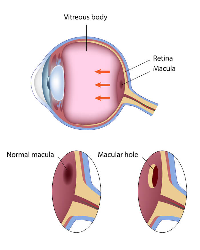 Diagram of macular hole