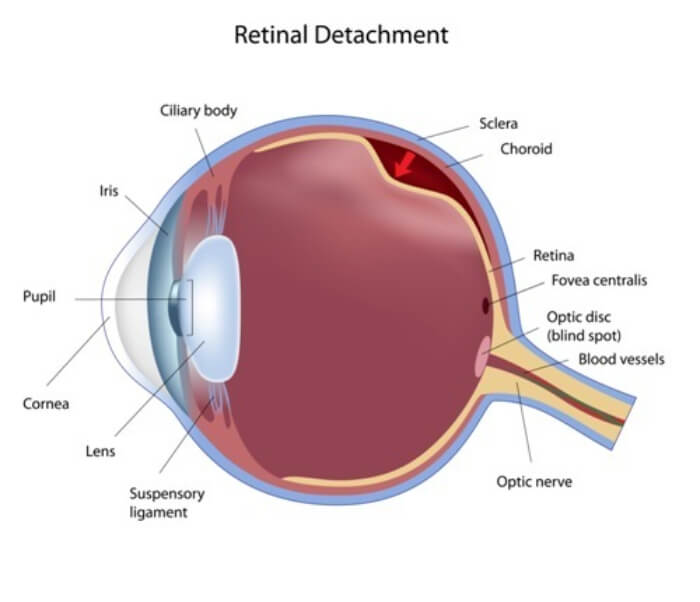 Retinal Detachment diagram