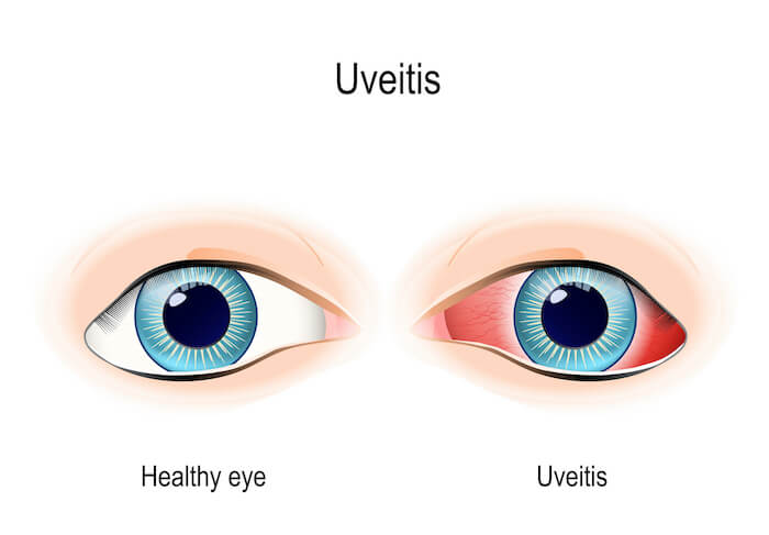 Uveitis eye vs. healthy eye diagram